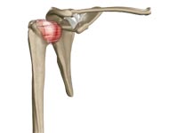 Frozen Shoulder