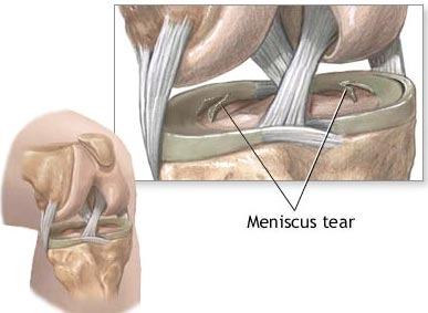 Overview of Meniscus Tears