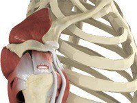 Rotator Cuff Tear