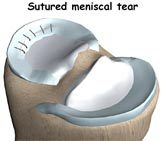 Meniscus and Cartilage Repair Surgery