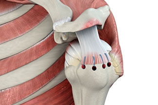 Anatomic tear deterioration was associated with nonoperative treatment of rotator cuff tears