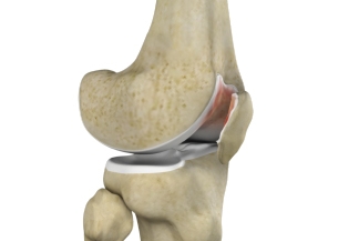 Chondromalacia Patellae Symptoms and Treatment