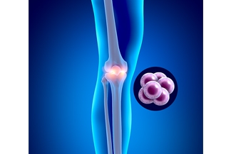 Clinical trial shows promise of stem cells in offering safe, effective relief from arthritic knees