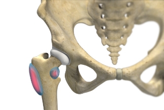 Common Cause of Pain With Hip Bursitis