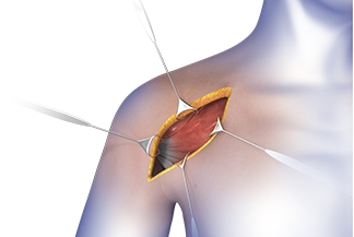 Higher risk for infection associated with previous non-arthroplasty related shoulder surgery