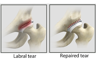 Hip Labrum Surgery: Is It The Right Treatment?