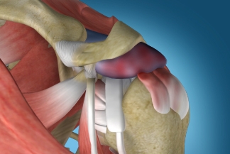 Internal Impingement Shoulder Injuries Overview