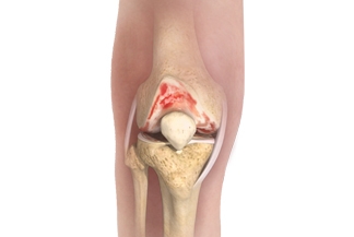 Knee osteoarthritis: A low-carb diet may relieve symptoms