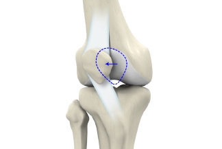 Kneecap Dislocation