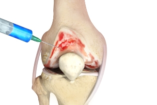 New device sheds light on mechanism, efficacy of arthritis treatment