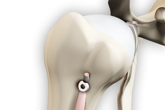 Rotator cuff repair with biceps tenodesis did not impact speed of recovery after surgery