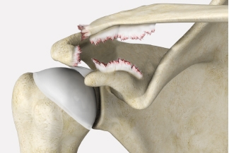 Shoulder Separation Causes, Symptoms and Treatments