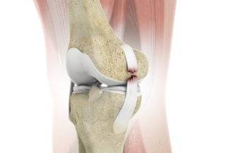 Treatment and Recovery Time for MCL Tears