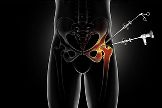What To Expect After Hip Arthroscopy