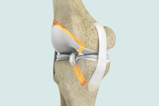 Young athletes who require ACL reconstruction may benefit from additional procedure