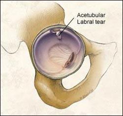 Acetubular Labral Tear