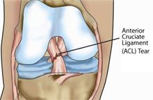 Symptoms of ACL tears