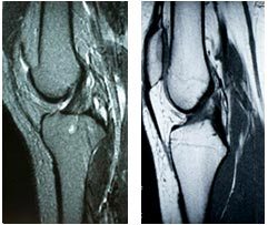 How Are ACL Tears Diagnosed?