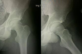 After Arthroscopic Impingement Resection