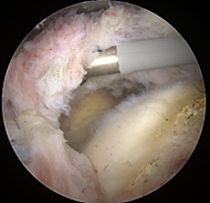 Before and after allograft augmentation and reconstruction of a rotator cuff tear.