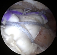 Before and after allograft augmentation and reconstruction of a rotator cuff tear.