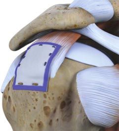 Allograft Augmentation for Rotator Cuff Tears