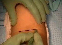 Distal Biceps Tendon Repair