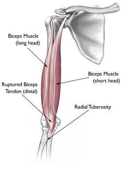 Distal Biceps Tendon Tear