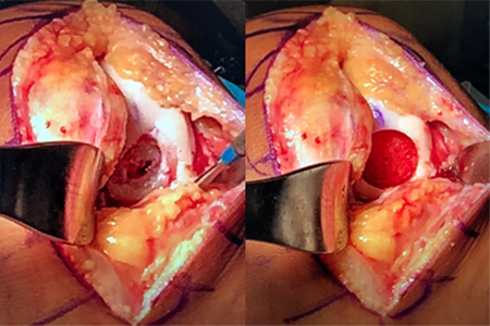 Femoral condyle osteochondral lesion is prepared to receive the osteochondral allograft