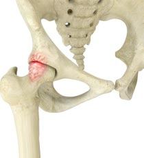 Hip Impingement (Femoroacetabular Impingement Or FAI)