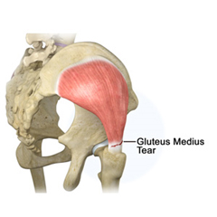 Gluteus Tendon Tear