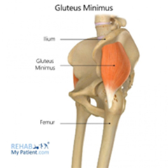 Gluteus Tendon Tear