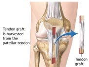 ACL Tear Treated Surgically