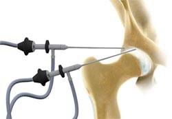 Hip Arthroscopy