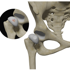 Hip Cartilage Repair