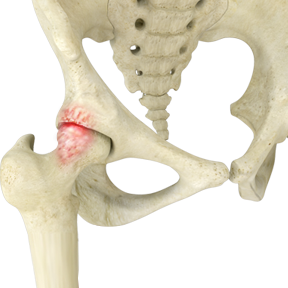 Abnormal Hip Bone Prominences