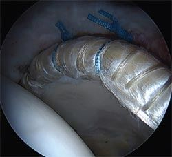 Hip labrum allograft reconstruction