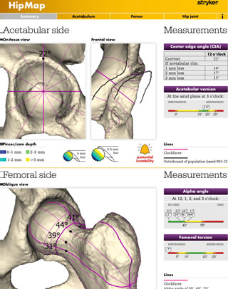 Stryker HipMap and HipCheck