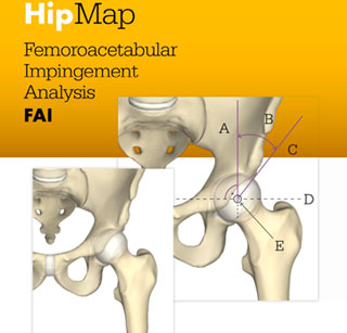 Stryker HipMap and HipCheck