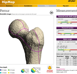 Stryker HipMap and HipCheck