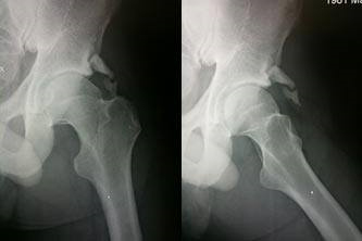 Hip Impingement
