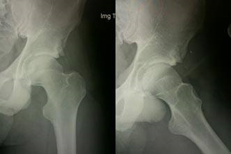 Hip Impingement