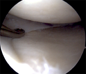 Meniscus allograft after implantation.