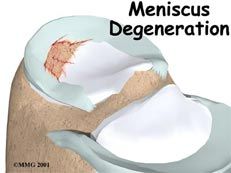 Meniscus Degeneration