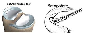 Meniscus Tear Treated Surgically