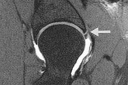 MRI scan Showing Labrum Tear