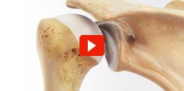 Multimedia Patient Educaion Videos for Dr. J. Pieter Hommen - Orthopedic Surgeon & Sports Medicine