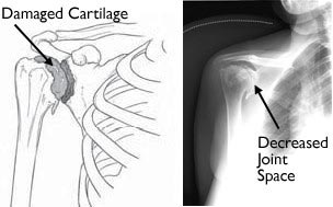 Osteoarthritis