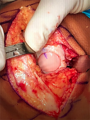 Osteochondral allograft implanted into the knee.