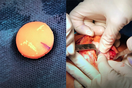 The osteochondral lesion allograft is prepared and implanted into the recipient site with a press-fit technique.